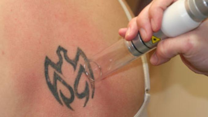 Laser Tattoo Removal All Colours | Rachels Beauty World