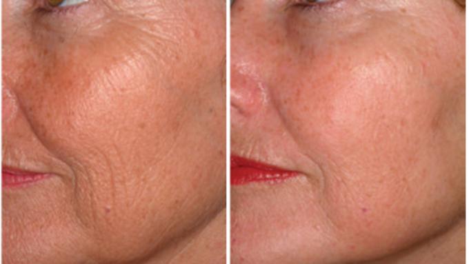 Palomar pic before after skin resurfacing