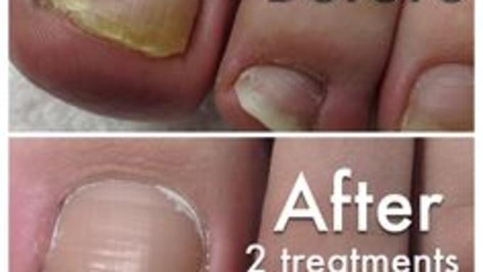 Fungal Nail Infection Removal