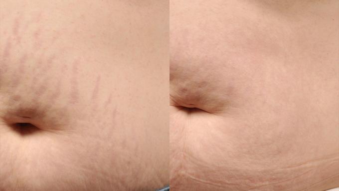 Icon S Doherty stretchmark2 stomach.prepost3Tx