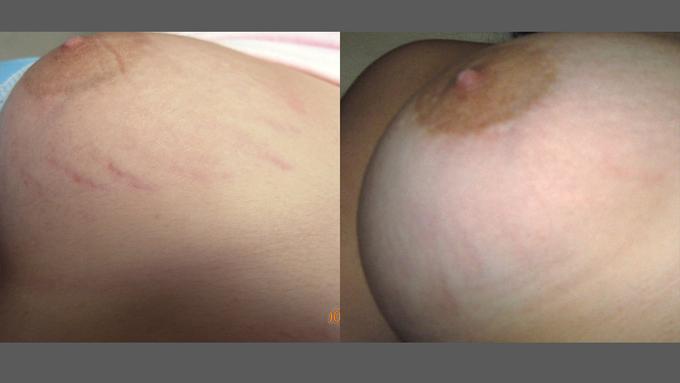 Icon F de Angelis stretchmark breast prepost3Tx