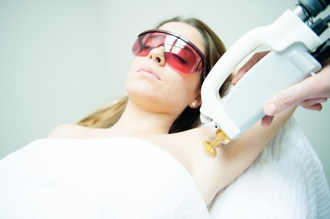 Laser hair removal