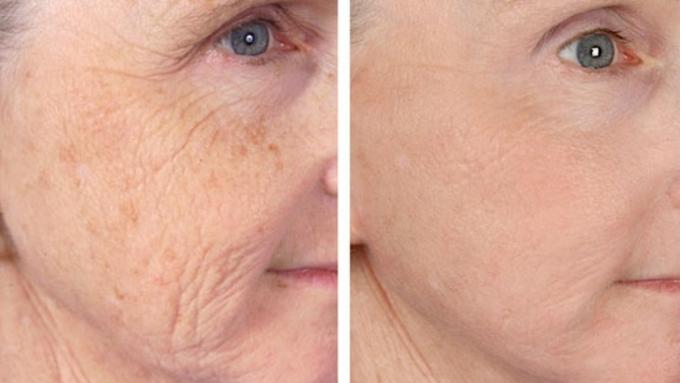 Anti aging Laser Facial Rachels Beauty World